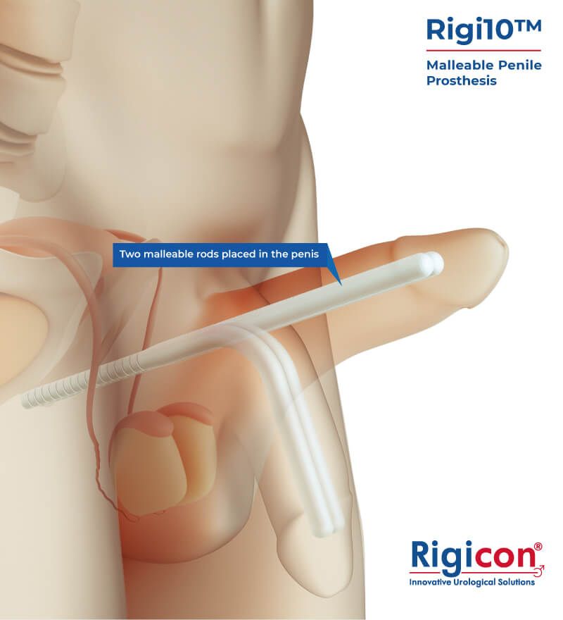 Rigi10™ Malleable Penile Prosthesis Product Illustration