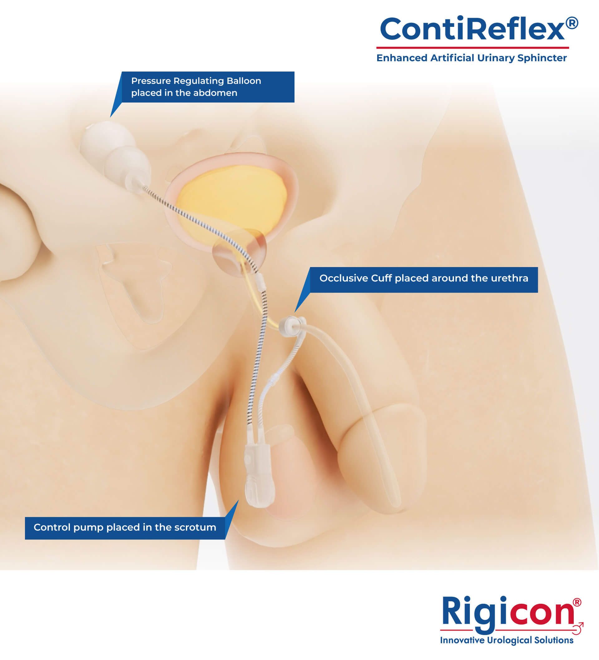 ContiReflex Enhanced Artificial Urinary Sphincter Product Illustration