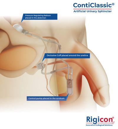 ContiClassic® Artificial Urinary Sphincter Product Illustration